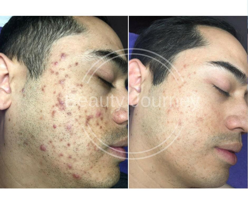 Trigger Healthy Skin With DMK Enzyme Therapy