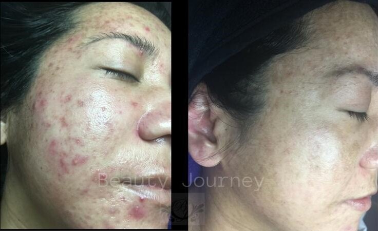 Acne Scars, Yes, All Acne scars Can Be treated!