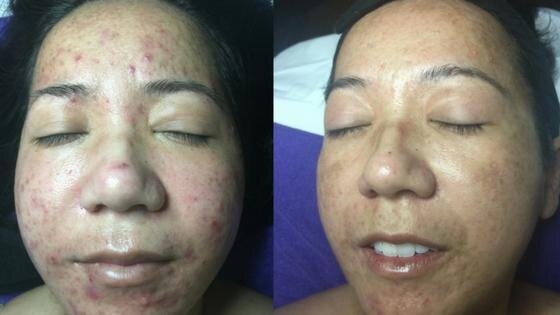 Winning the War On Acne