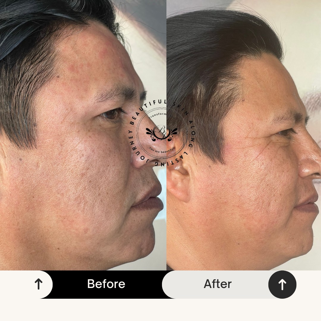 Acne Scars